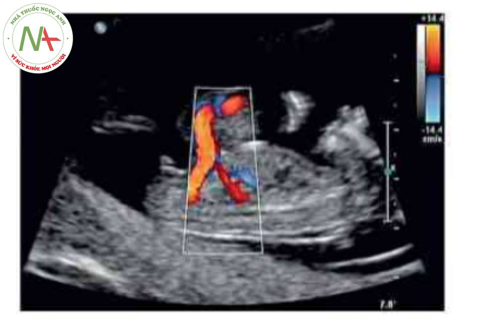 Hình 4 Các mạch máu dây rốn chạy qua khối thoát vị rốn của thai nhi được thấy ờ mặt cắt dọc lúc thai 13 tuần tuồi