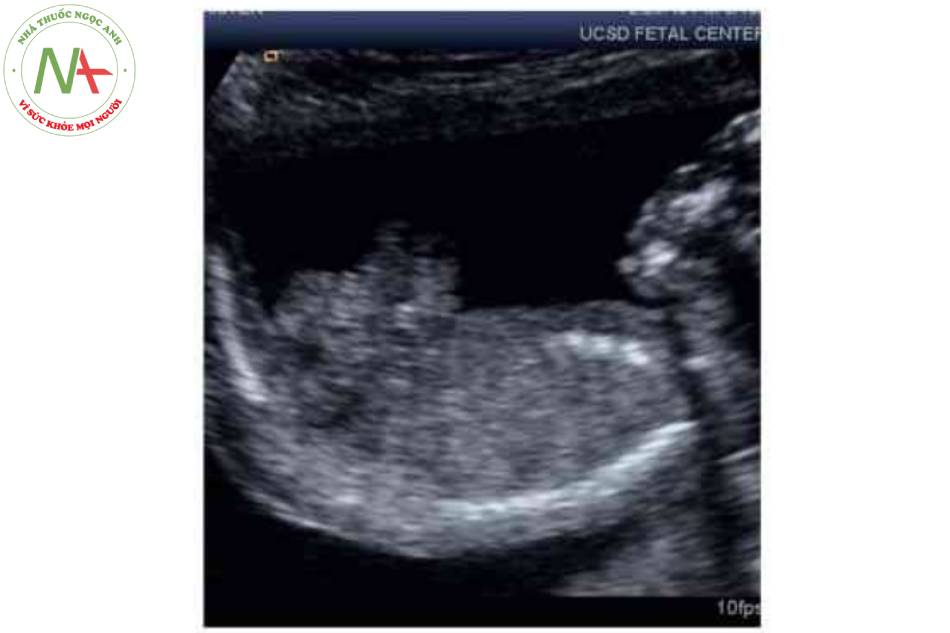 Hình 4. Mặt cắt dọc của thai nhi 20 tuần tuổi cho thấy khe hở thành bụng ờ bụng dưới (mũi tên) với hình ánh súp lơ điển hình