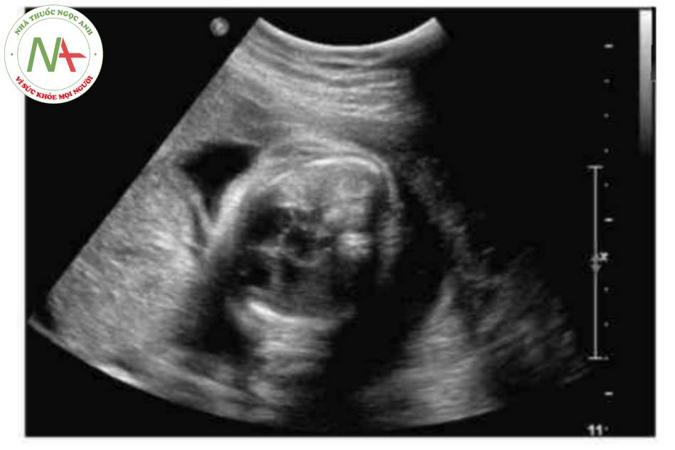 Hình 5 Trục tim lệch trái ở thai nhi 29 tuần bị thoát vị rốn và gan ngoài cơ thể