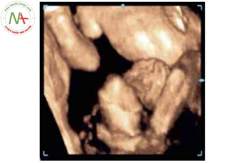 Hình 5. Hình ảnh 3D của thai nhi 22 tuần tuổi cho thấy rò ràng khe hò thành bụng ờ giữa bụng dưới (đầu mũi tên) với hình ảnh súp lơ