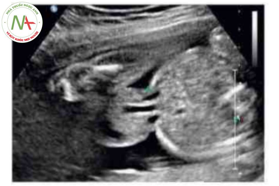 Hình 6 Khiếm khuyết thành bụng cố kích thước 2,23 cm được thấy ở thai nhi 25 tuần tuổi