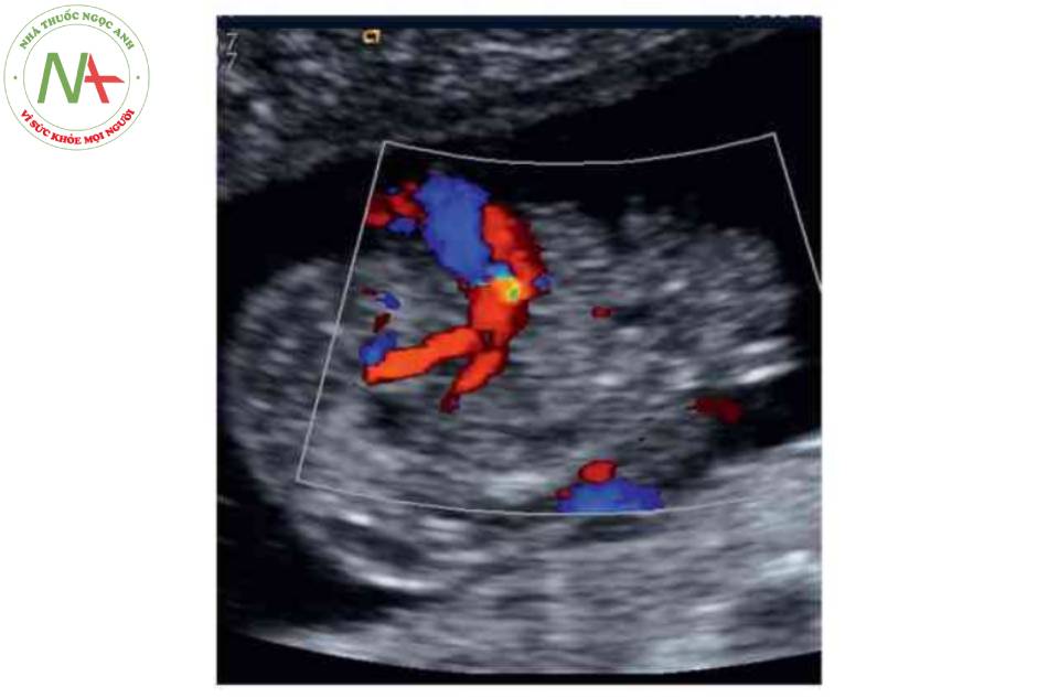 Hình 6. Mặt cắt ngang thai nhi 20 tuần tuổi có khe hờ thành bụng (mũi tên) mỡ rộng sang bên phải vị trí cắm của dây rốn. BI, Bàng quang