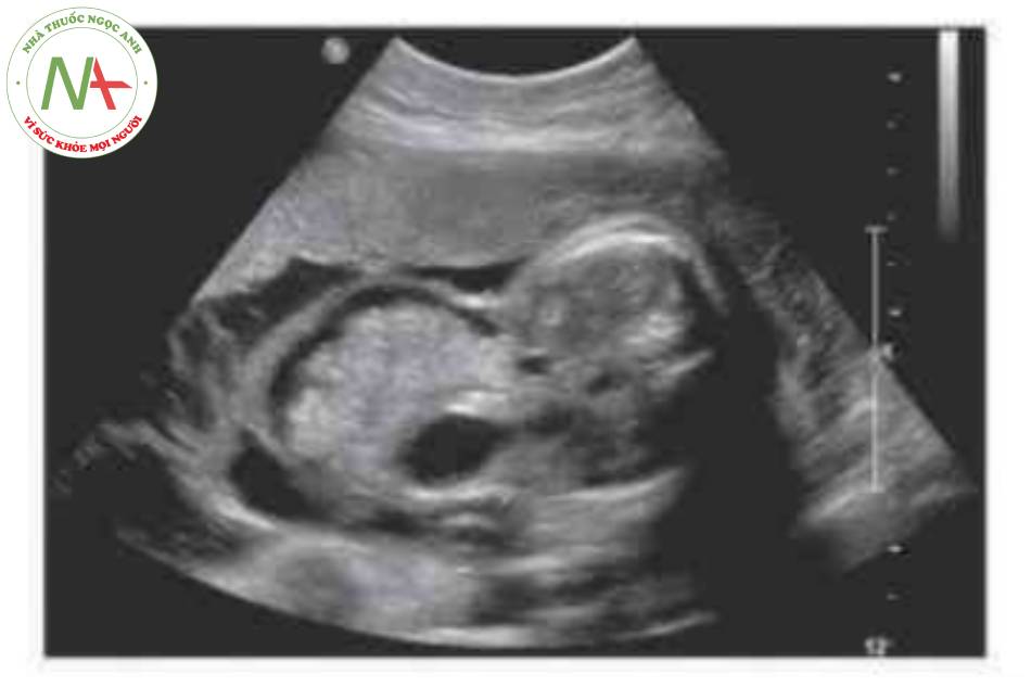 Hình 7 Khiếm khuyết thành bụng có kích thước 4,23 cm được thấy ờ thai nhi 28 tuần tuổi. ST, Dạ dày.