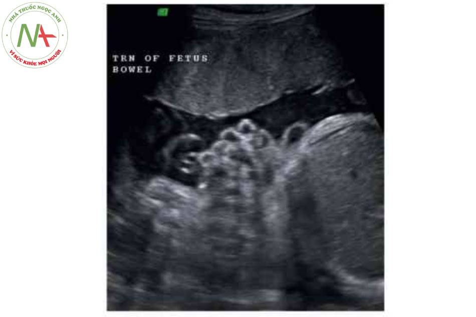 Hình 7 Mặt cắt ngang cho thấy ruột giãn nhẹ điển hình kèm theo khe hờ thành bụng (mùi tên) ở thai nhi gần đú tháng
