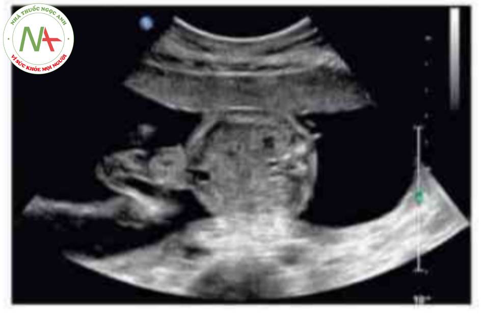 Hình 8 Thoát vi rốn với gan trong ổ bụng được thấy ở thai nhi 22 tuân tuổi. Thai nhi này được chân đoản là trisomy 18.