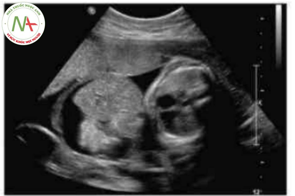 Hình 9 Thoát vị rốn lớn với cổ chướng được thấy ở thai nhi 29 tuần tuổi