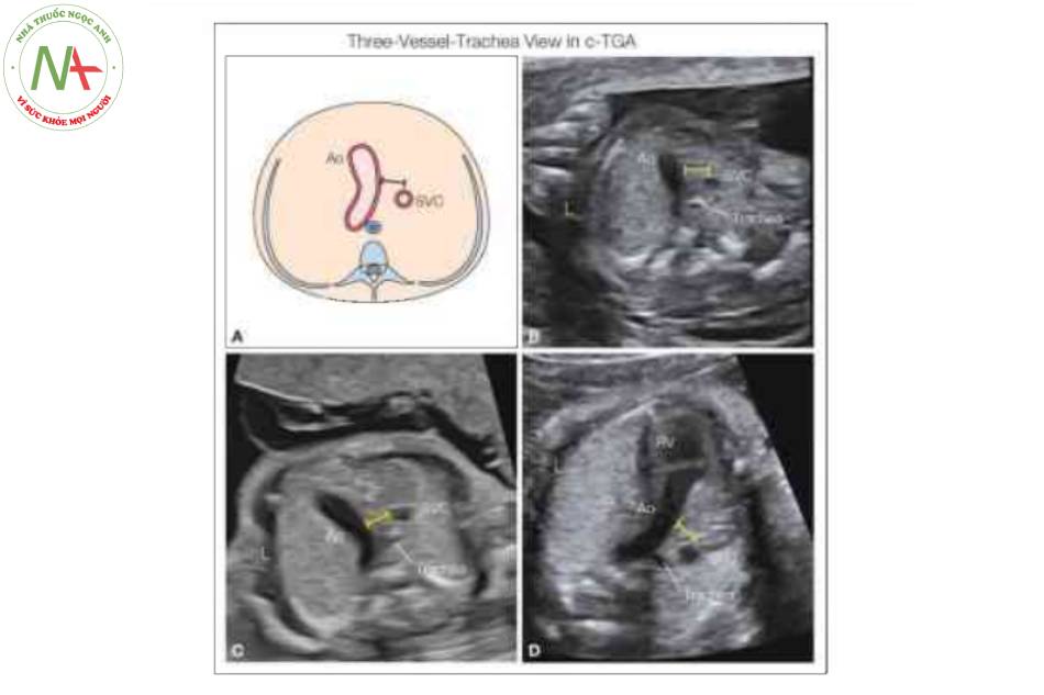 Hình 9: Hình vẽ giản đồ (A) và các mặt cắt ba mạch máu-khí quản từ mỏm tương ứng trong chuyển vị đại động mạch có sửa chữa (C-TGA) ở ba thai nhi lúc 17 (B), 22 (C) và 27 (D) tuần tuổi