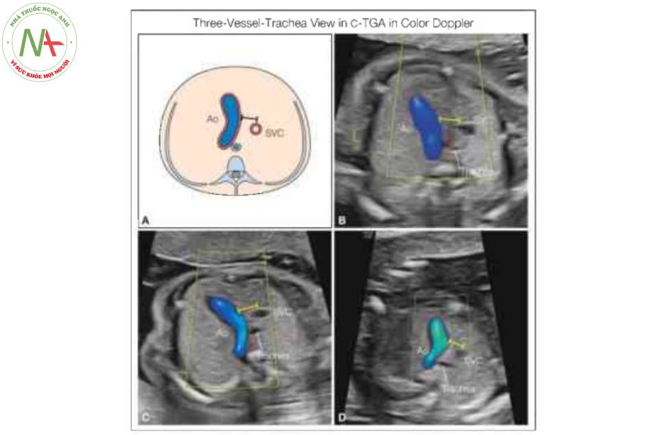 Hình 13: Hình vẽ giản đồ (A) và mặt cắt ba mạch máu-khí quản từ mỏm tương ứng ở ba thai nhi (B-D) với chuyển vị đại động mạch có sửa chữa (C-TGA).