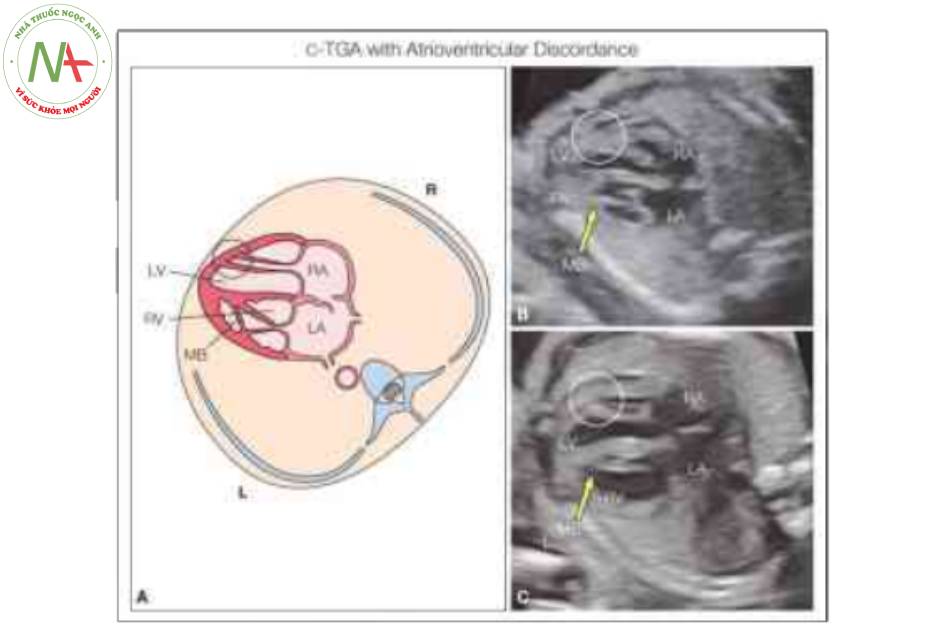 Hình 5: Hình vẽ giản đồ (A) và mặt cắt bốn buồng từ bên tương úng (B, C) ở hai thai nhi với chuyển vị đại động mạch có sửa chữa (C-TGA)