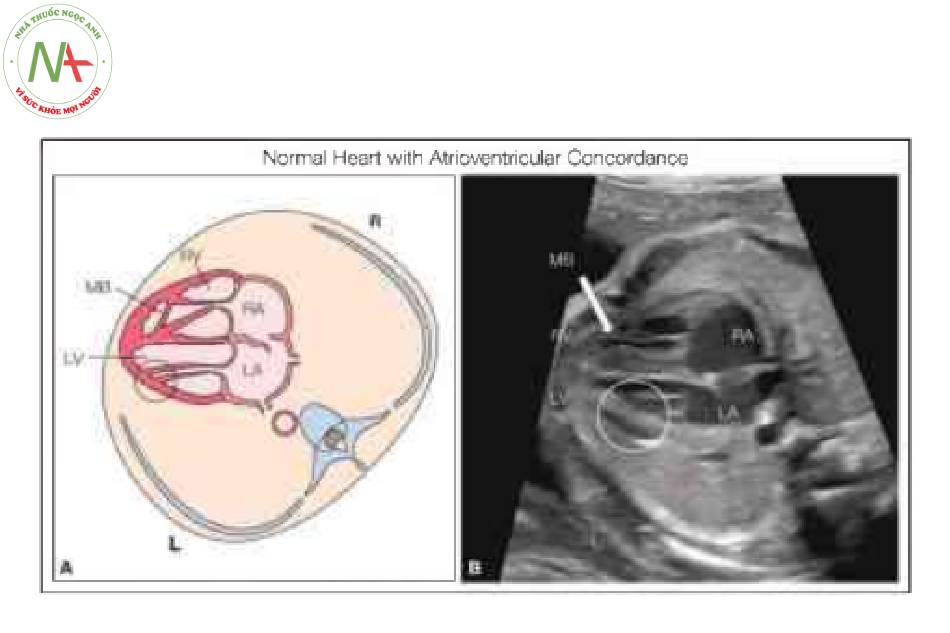 Hình 4: Hình vẽ giản đồ (A) và mặt cắt bốn buồng từ bên tương ứng (B) ở thai nhi bình thường.
