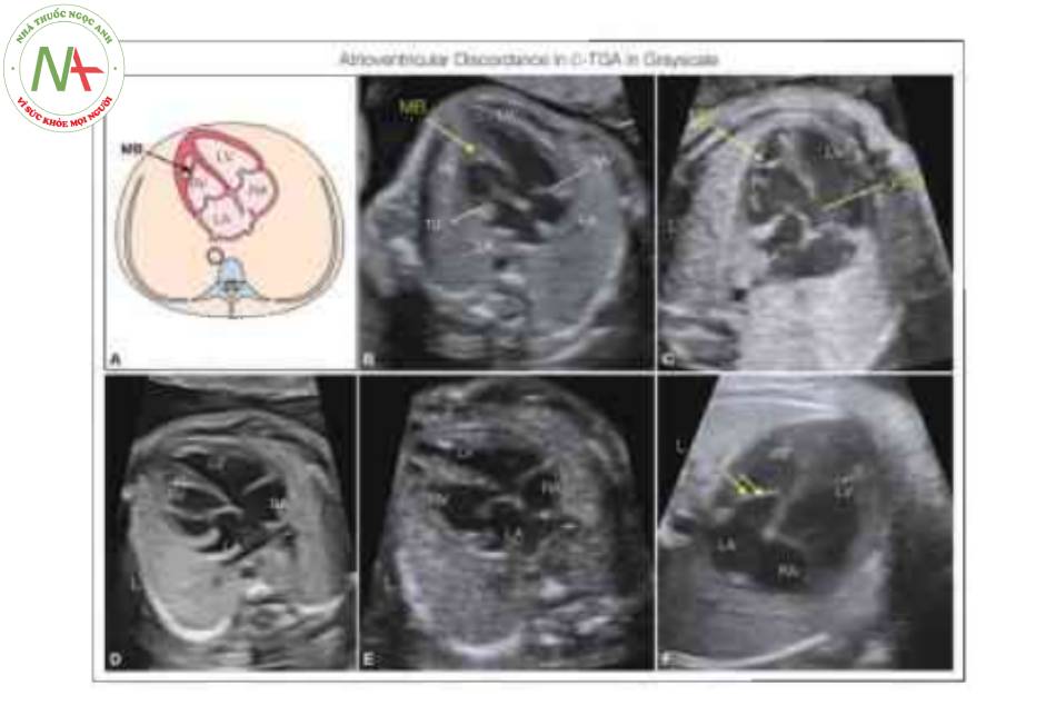 Hình 3: Hình vẽ giản đồ (A) và mặt cắt bốn buồng từ mỏm ở 5 thai nhi khác nhau với chuyển vị đại động mạch có sửa chữa (C-TGA) và levocardia