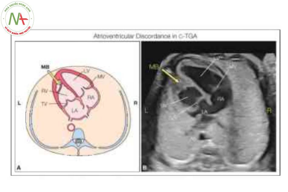 Hình 2: Hình vẽ giản đồ (A) và mặt cắt bổn buồng từ mom (B) ở một thai nhi với chuyển vị đại động mạch có sửa chữa (C-TGA) cho thấy sự bất tương hợp điển hình của các kết nối nhĩ thất