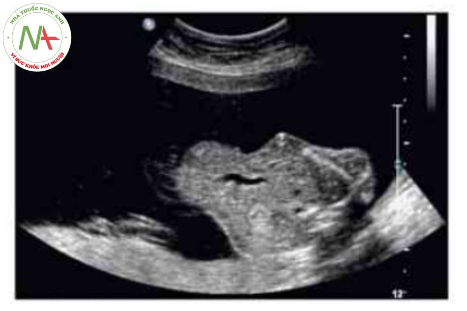 Hình.1 Thoát vị rốn với gan ngoài cơ thể được thấy ở mặt cắt ngang lúc thai 21 tuần tuồi. n đoán được đưa ra là hội chứng Beckwith-Wiedemann.