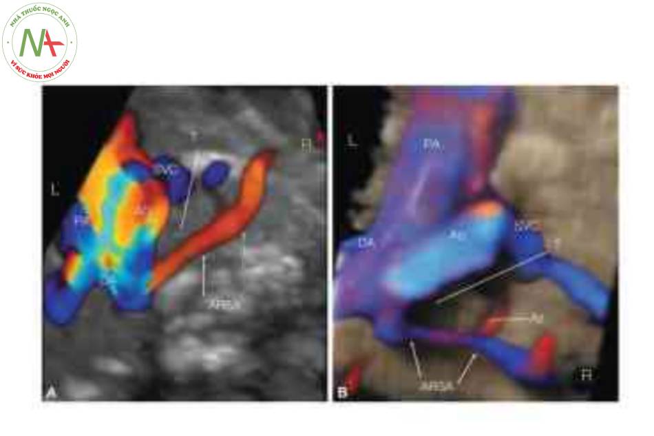 Khối tương quan hình ảnh không gian thời gian trong Doppler màu và chế độ cơ thể trong suốt ở hai thai nhi (A, B) cho thấy đường đi của động mạch dưới đòn phải lạc chỗ (ARSA) sau khí quản (T)