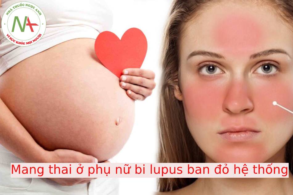 Mang thai ở phụ nữ bi lupus ban đỏ hệ thống