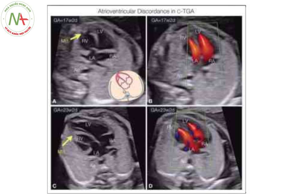 Hình 10: Mặt cắt bốn buồng ở một thai nhi với chuyển vị đại động mạch có sửa chữa (CTGA) lúc 17 (Hình A, B) và 23 (Hình C, D) tuần tuổi trong thang xám và Doppler màu.