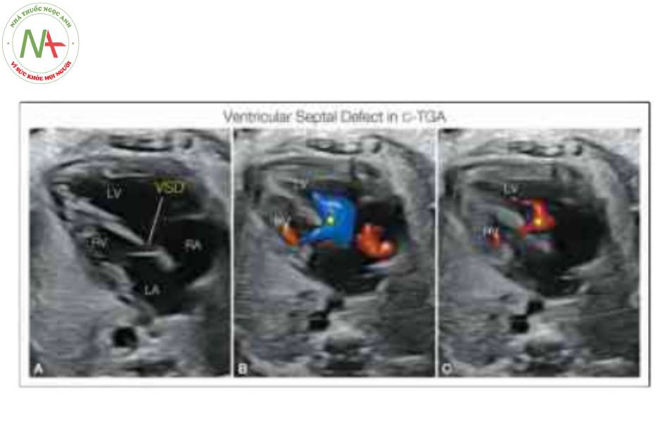Hình 11: Mặt cắt bốn buồng trong thang xám (A) và Doppler màu trong thời kỳ tâm thu (B) và tâm trương (C) ở một thai nhi với chuyển vị đại động mạch có sửa chừa (C-TGA) và thông liên thất