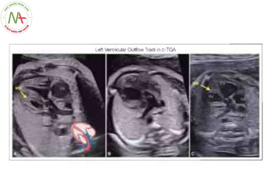 Hình 8: Mặt cắt đường ra thất trái từ bên (A) và mỏm (B, C) ở ba thai nhi với chuyển vị đại động mạch có sửa chữa (C-TGA).