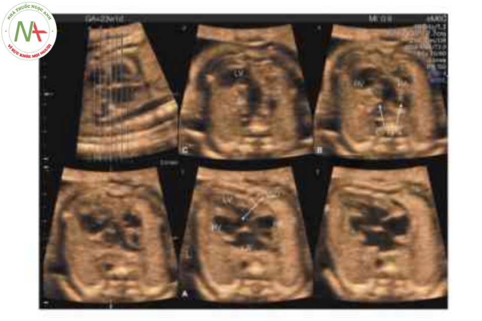 Hình 19: Siêu âm 3D khối hình ảnh tương quan không gian thời gian (STIC), được hiển thị ở chế độ chụp cắt lớp, ở một thai nhi với chuyển vị đại động mạch có sửa chữa