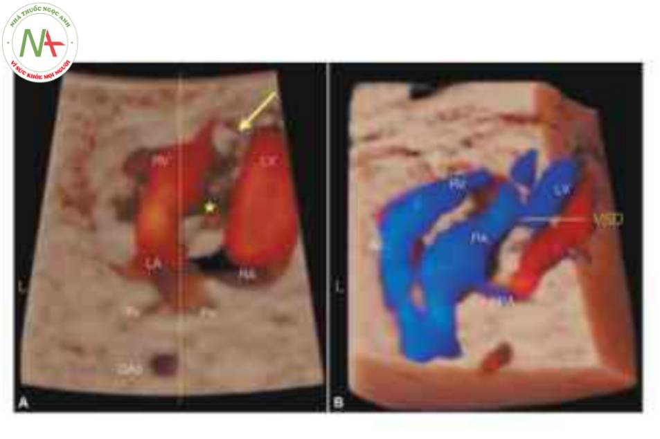 Hình 21: Siêu âm 3D khối hình ảnh tương quan không gian thời gian (STIC), được hiển thị ở chế độ cơ thể trong suốt, ở một thai nhi với chuyển vị đại động mạch có sửa chữa (C-TGA) và dextrocardia