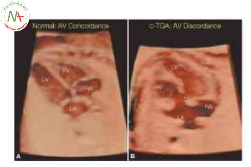 Hình 20: Siêu âm 3D khối hình ảnh tương quan không gian thời gian (STIC) được hiển thị ở chế độ dụng hình bề mặt ở hai thai nhi với tim bình thường (A) và với chuyển vị đại động mạch có sửa chữa (C-TGA) (B)