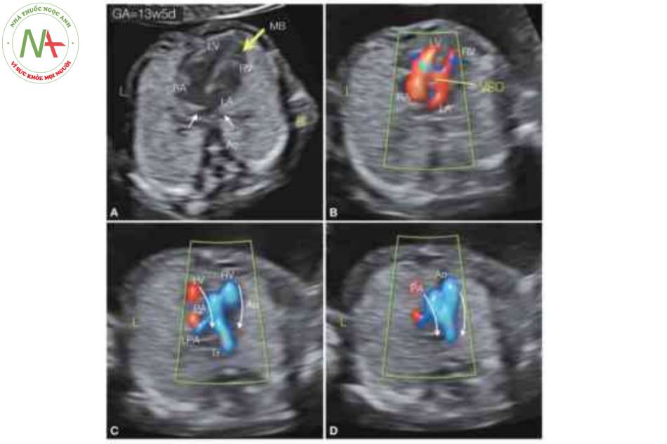 Hình 18: Siêu âm tim thai độ phân giải cao và Doppler màu của thai nhi được trình bày trên Hình 17, được thực hiện lúc 13 tuần tuổi.