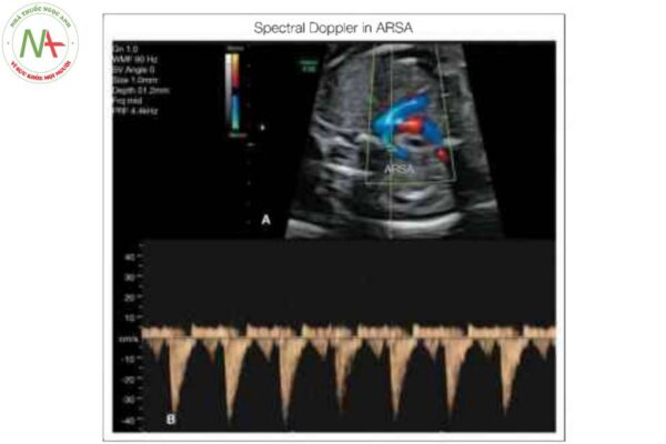 Thai nhi có động mạch dưới đòn phải lạc chỗ (ARSA) được thấy trên Doppler màu (A) và dạng dòng chảy động mạch của nó được xác nhận với Doppler phổ (B)