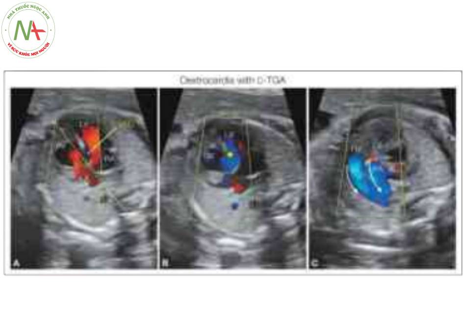 Hình 15: Thai nhi với chuyển vị đại động mạch có sửa chữa (C-TGA) và dextrocardia được cho thấy trong Doppler màu ở ba mặt cắt siêu âm (A-C)