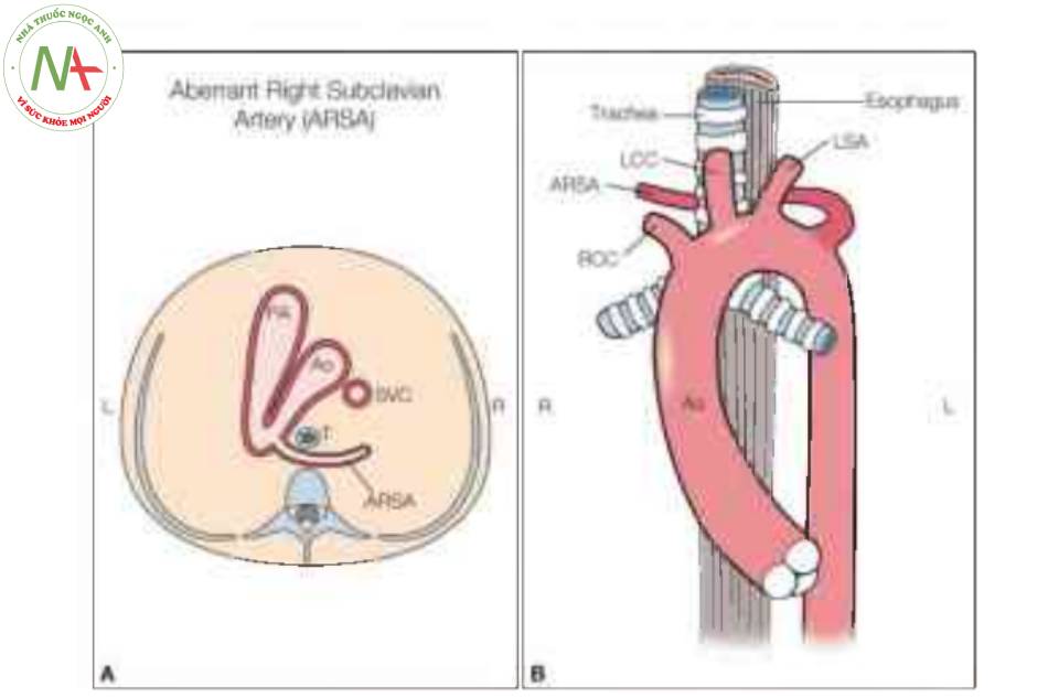 Hình vẽ giản đồ của mặt cắt ba mạch máu-khí quản (A) và nhìn trực diện (B) của động mạch dưới đòn phải lạc chỗ (ARSA)