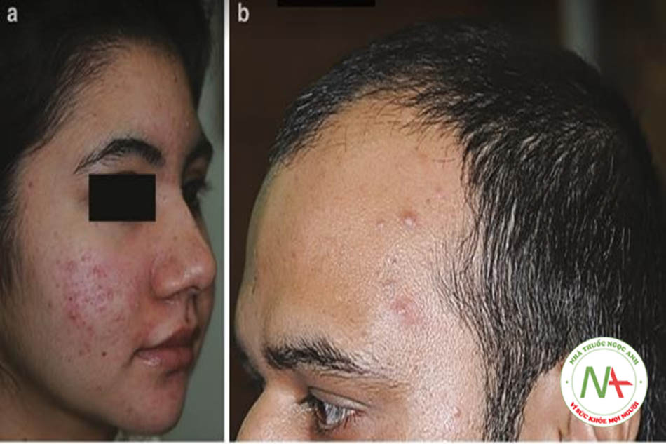 Hình 9.8 (a) Malassezia IRAA - vùng giữa mặt và dọc theo chân tóc, cho thấy mụn mủ nông và viêm da tiết bã. (b) Malassezia IRAA ở người trưởng thành, có khuynh hướng biểu hiện ở vùng trên mặt. Đã ghi nhận trường hợp MPHL với nam tương đương PCOS