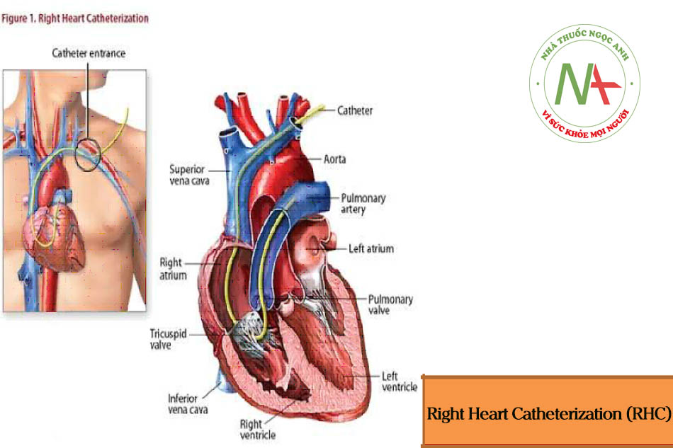 Right Heart Catheterization (RHC)