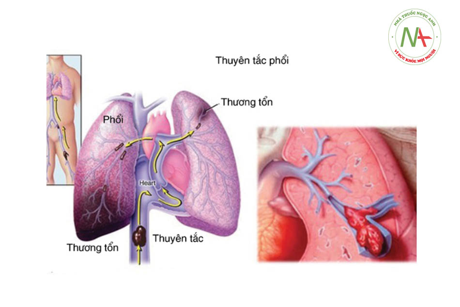 Chẩn đoán tăng áp phổi mạn do thuyên tắc huyết khối