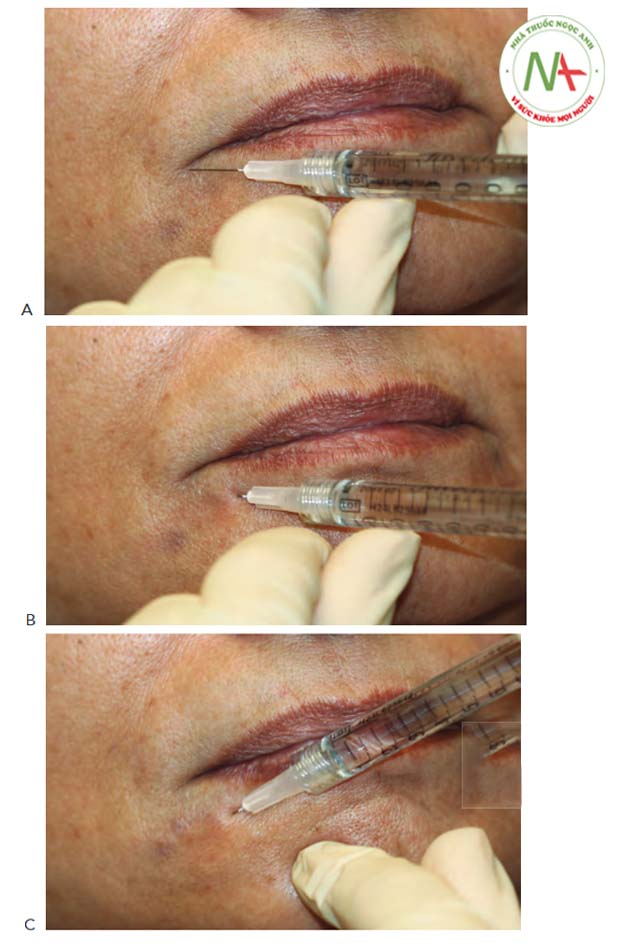 FIGURE 6 ● Phương pháp tiêm hình Quạt bên để điều trị chất độn da ở nếp nhăn cằm: xác định điểm tiêm (A) và kỹ thuật tiêm (B, C)