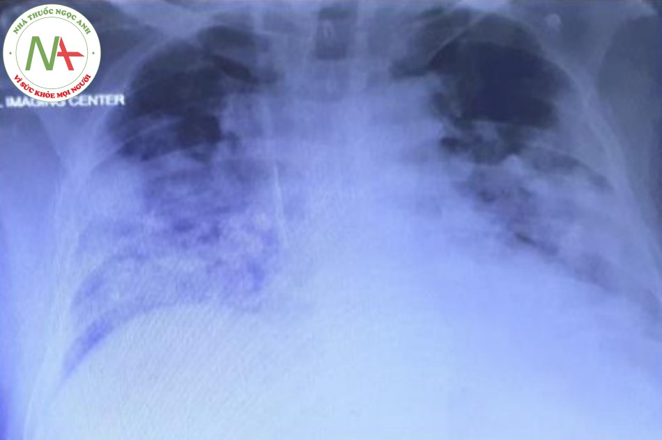 Hình 3. X - quang ngực của bệnh nhân trong thời gian chuyển từ ICU đến khoa nội tổng quát.