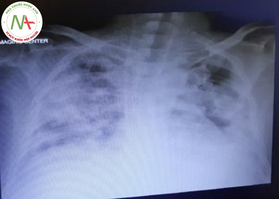 Hình 1. X - quang ngực của bệnh nhân khi nhập ICU.