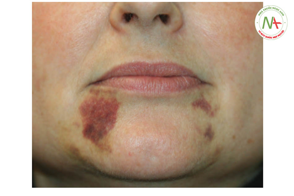 Hình1 Bầm tím rộng, 2 ngày sau khi điều trị làm đầy da (Radiesse®, một sản phẩm canxi hydroxylapatite bán vĩnh viễn).
