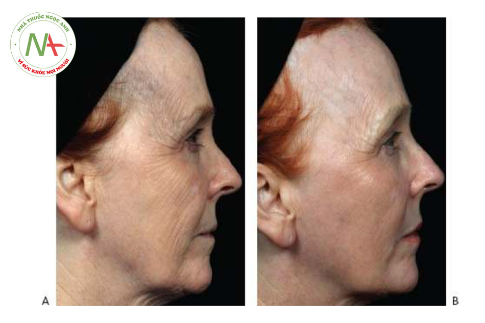 HÌNH 13 Tái tạo bề mặt da phân đoạn xâm lấn để điều trị nếp nhăn vùng mặt trước khi (A) và sau khi (B) 1 lần điều trị sử dụng laser carbon dioxide.