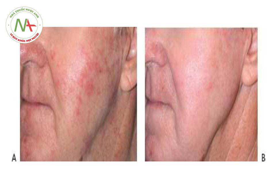 Hình 20 cho thấy dày sừng ánh sáng trước khi (A) và sau khi (B) hai lần điều trị tái tạo bề mặt da xâm lấn phân đoạn bằng cách sử dụng laser erbi-um (Profractional ™, Sciton).