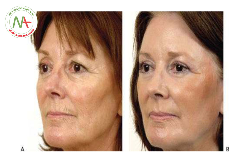 • Hình 12 cho thấy kết quả đối với các nếp nhăn trên khuôn mặt trước khi (A) và sau khi (B) một lần điều trị tái tạo bề mặt da xâm lấn sâu bằng cách sử dụng laser erbium đến độ sâu 120 μm (Contour TRL ™, Sciton)