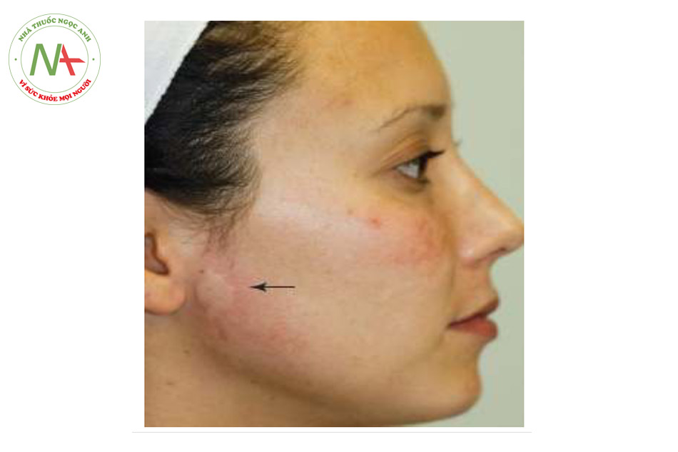 HÌNH 14 Mề đay trước tai sau khi điều trị tái tạo bề mặt da không xâm lấn. (với sự cho phép của BS R. Small)
