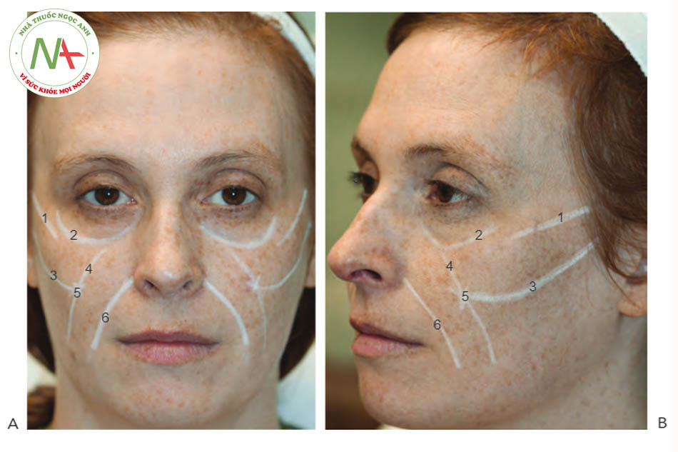 Hình 2.Các điểm chú ý trên khuôn mặt để điều trị bơm má bằng chất làm đầy nhìn từ phía trước (A) và bên (B)