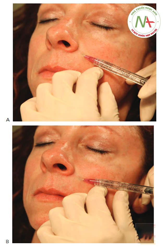 Hình 5 ●Hyaluronic acid chồng lớp trong điều trị các nếp gấp mũi má bên trên: lan dầnning từ (A) đến (B)