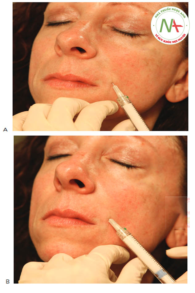 Hình 4 ●Calcium hydroxylapatite trong điều trị nếp gấp mũi má: lan dầnning từ (A) đến (B).