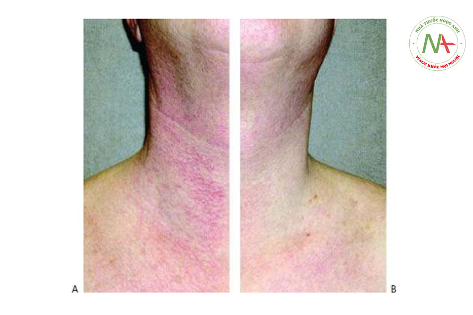 HÌNH 13 Điểm da của Civatte trên cổ trước khi (A) và sau khi (B) sau 2 lần điều trị với IPL.