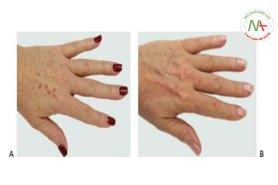 Hình 8 cho thấy đốm nâu trên tay trước khi (A) và sau khi (B) một loạt các phương pháp điều trị bằng cách sử dụng IPL (StarLux ™ với tay cầm LuxG, Cynosure / Palomar).