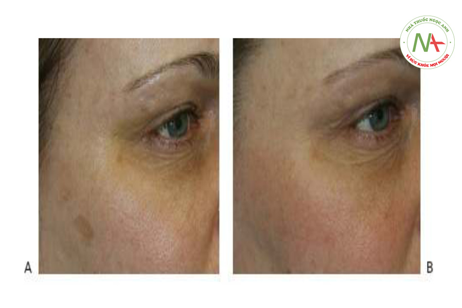 Hình 10 cho thấy đốm nâu và tăng sắc tố dưới mắt trước khi (A) và sau khi (B) hai phương pháp điều trị bằng cách sử dụng laser QS 532 nm (RevLite ™, Cynosure / ConBio).
