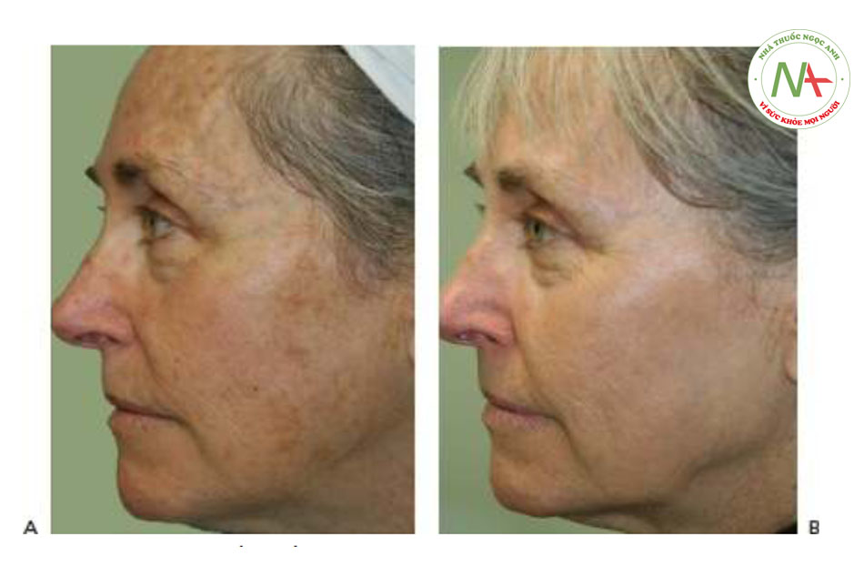 Hình 7 cho thấy đốm nâu và đường lằn sắc tố trên mặt trước khi (A) và sau khi (B) một loạt năm lần điều trị bằng cách sử dụng IPL (StarLux ™ với tay cầm LuxG, Cynosure / Palomar).
