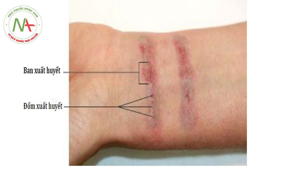 HÌNH 10 Đáp ứng lâm sàng của đốm xuất huyết và ban xuất huyết một vài phút sau khi làm laser điều trị xóa xăm. (với sự cho phép của BS R. Small)