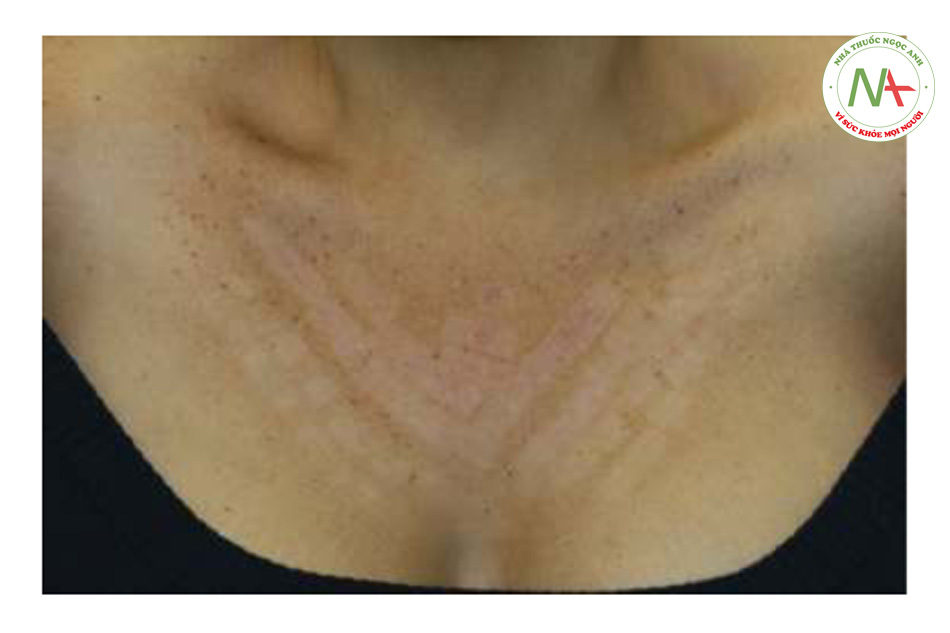 HÌNH 18 Giảm sắc tố vùng ngực ở bệnh nhân có loại da tối màu theo phân loại Fitzpat-rick 3 tháng sau khi 1 lần điều trị với IPL
