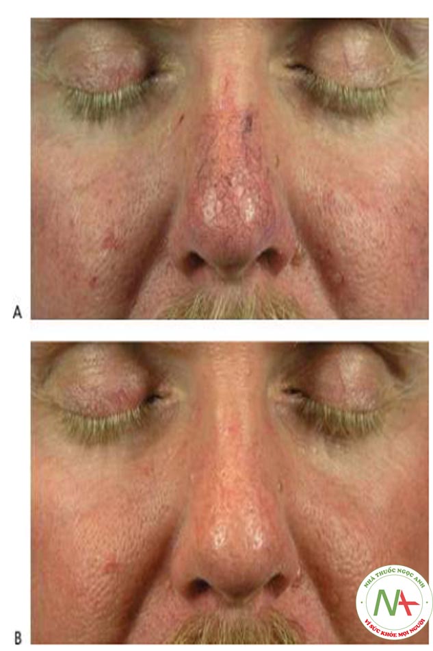 Hình 10 cho thấy giãn mao mạch trên mũi trước khi (A) và sau khi (B) một loạt lần điều trị bằng IPL (StarLux ™ với tay cầm LuxG, Cynosure / Palo-mar).